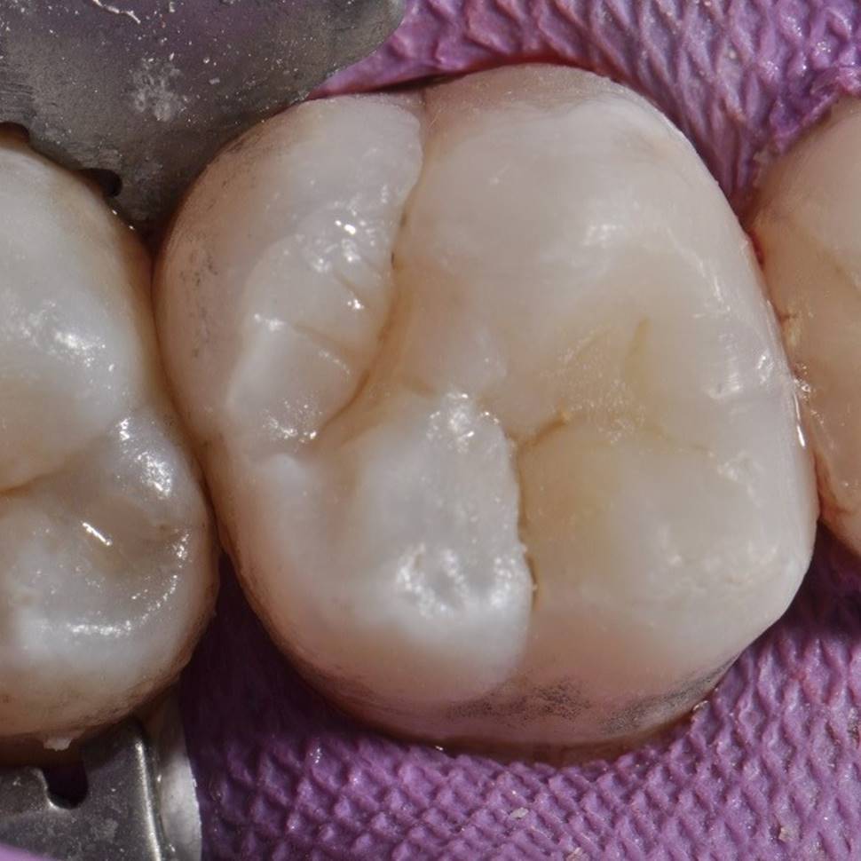wypełnienie zęba